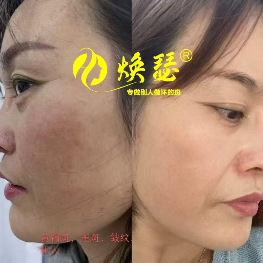 焕瑟祛斑鹰潭芬姐