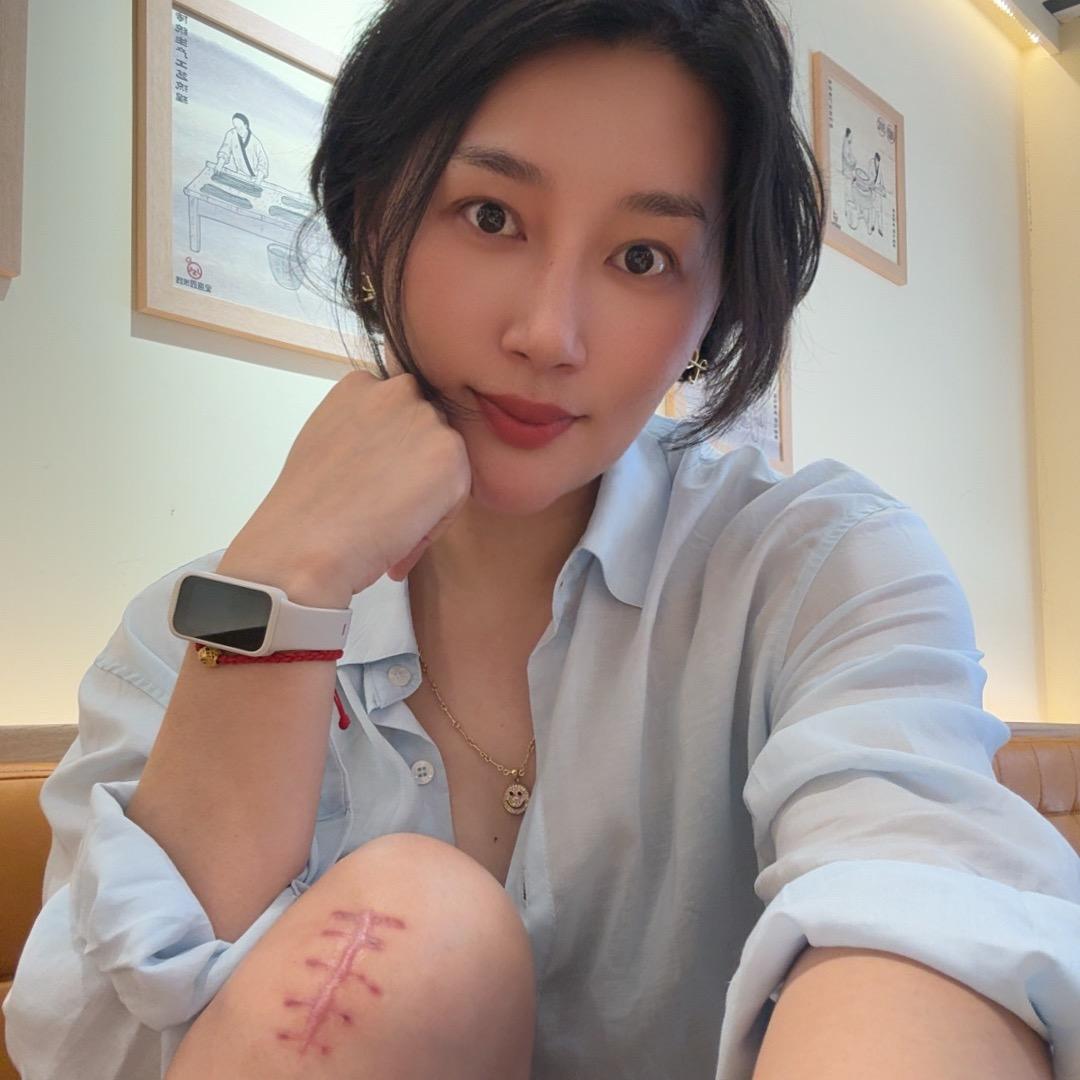 绵绵~胫骨髓内钉《脱拐版》