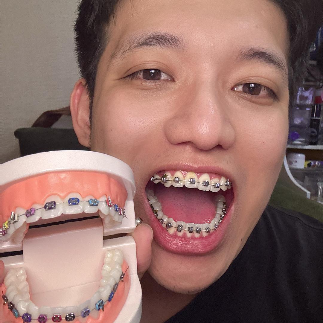 亦凡（正畸中）