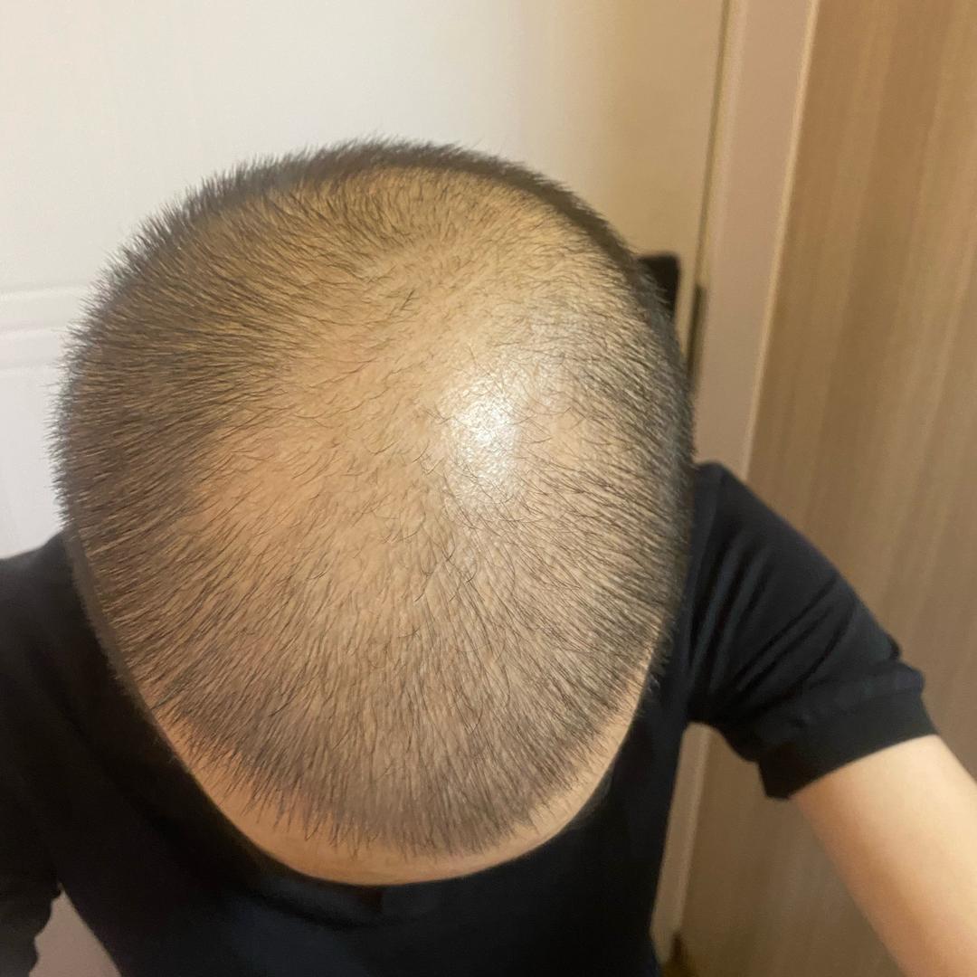 光头强养发
