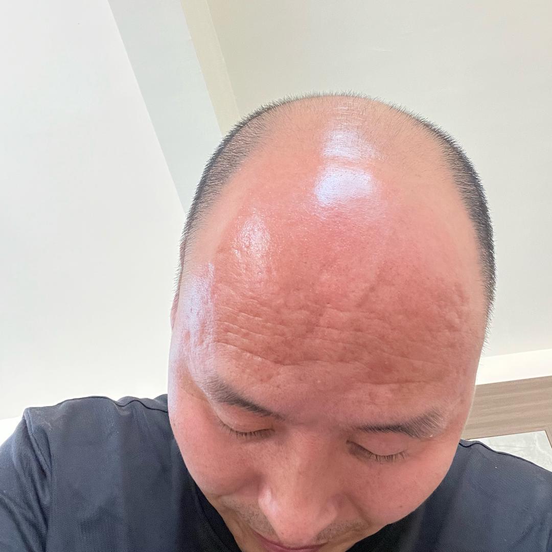 秃然不慌了