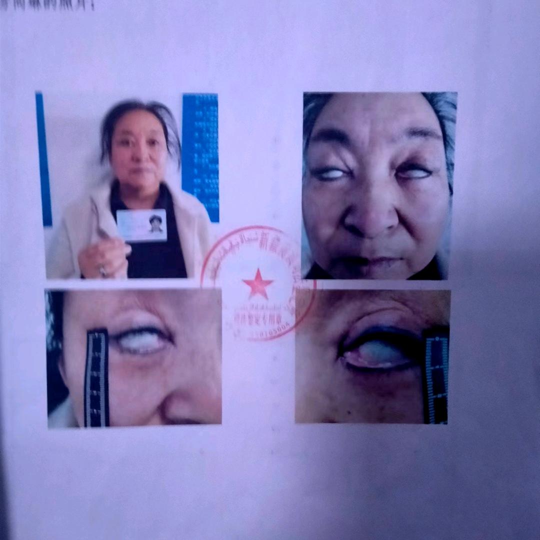 昌吉毁容案 艰辛维权路