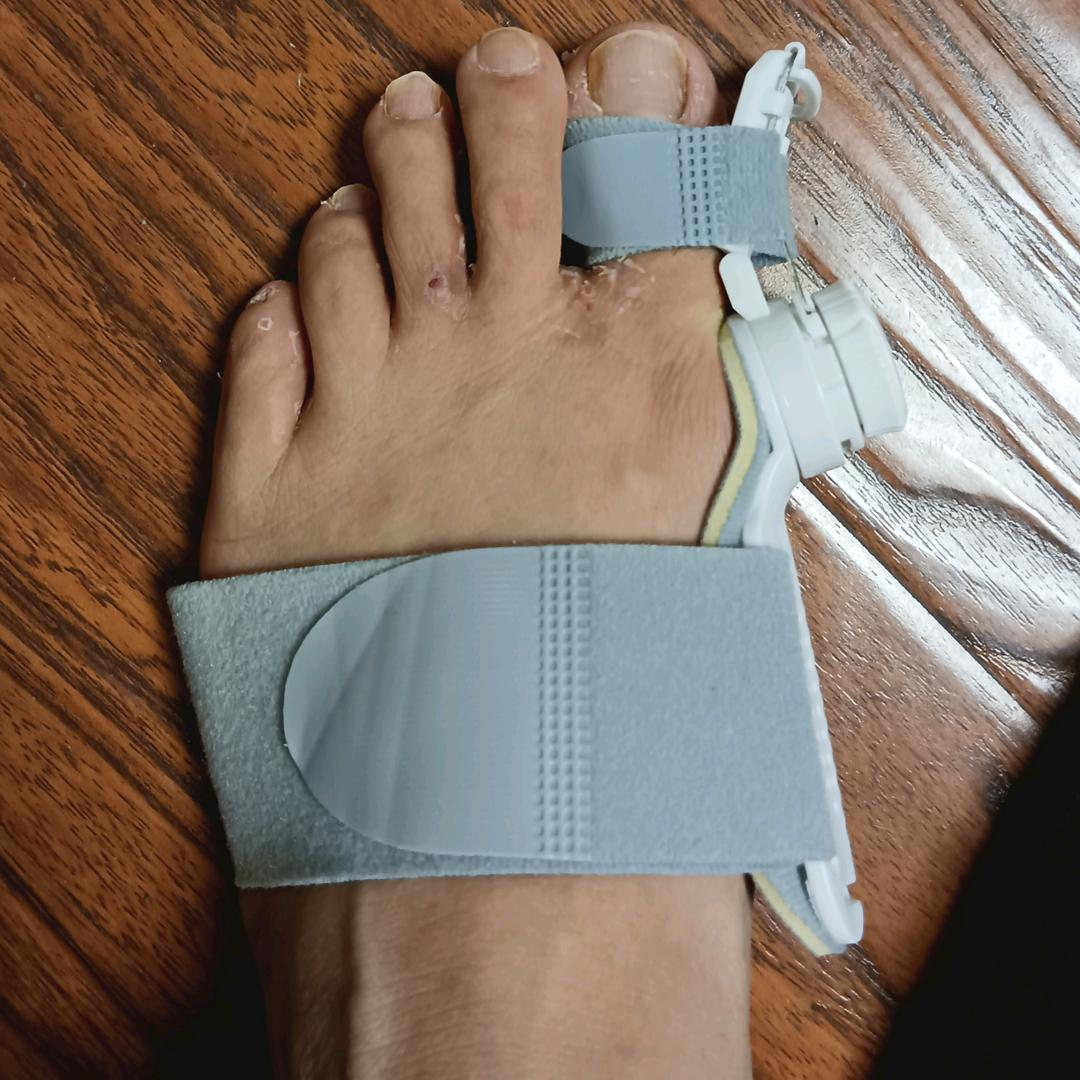 拇指外翻矫正器