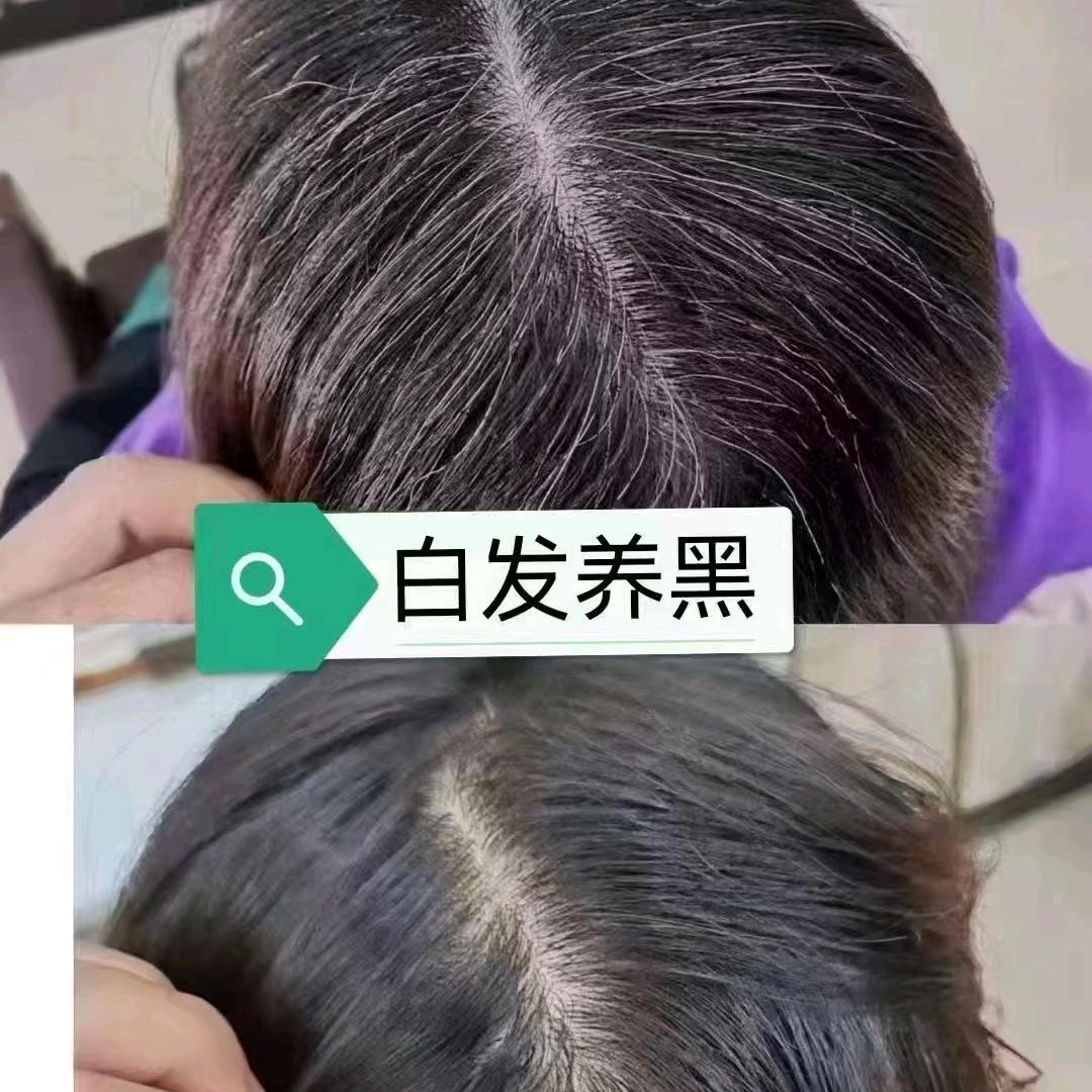 脱发白发找老张