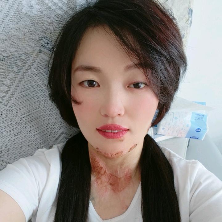 烧伤单身宝妈