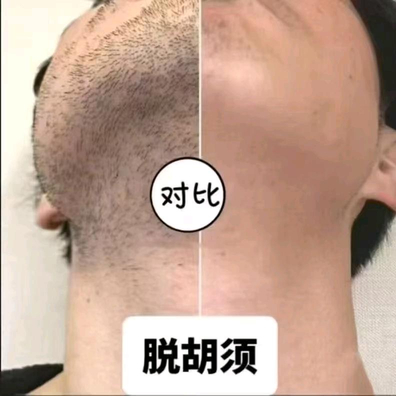 哈密专业胡须管理