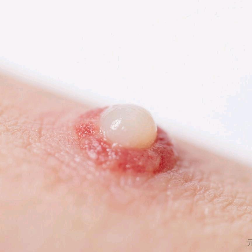 冒白头的青春痘