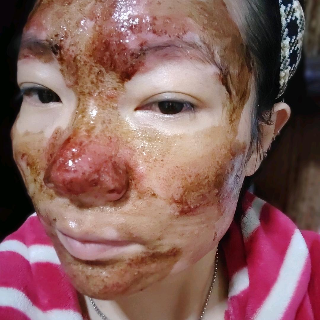 玫瑰痤疮激素烂脸(二妮)