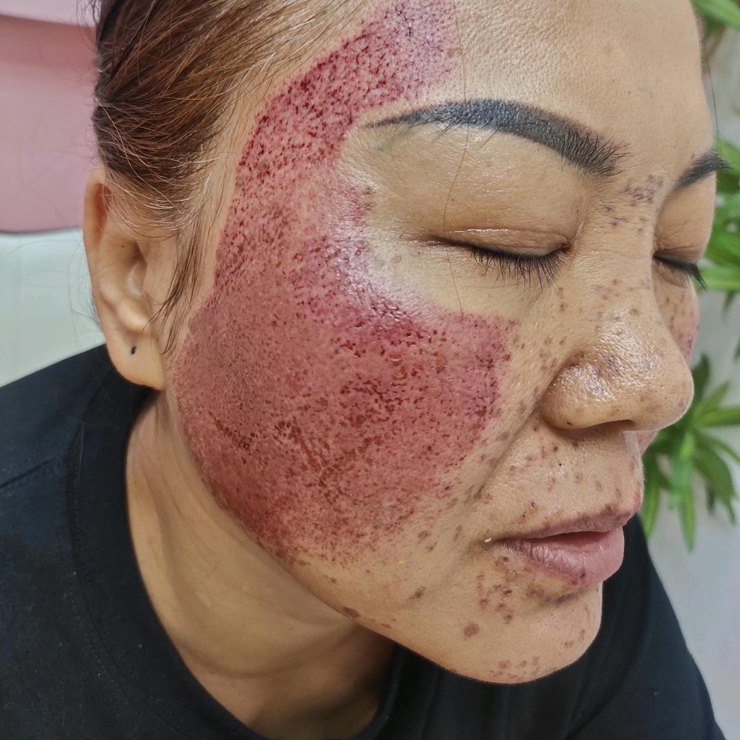 玖月🌹（祛斑后）