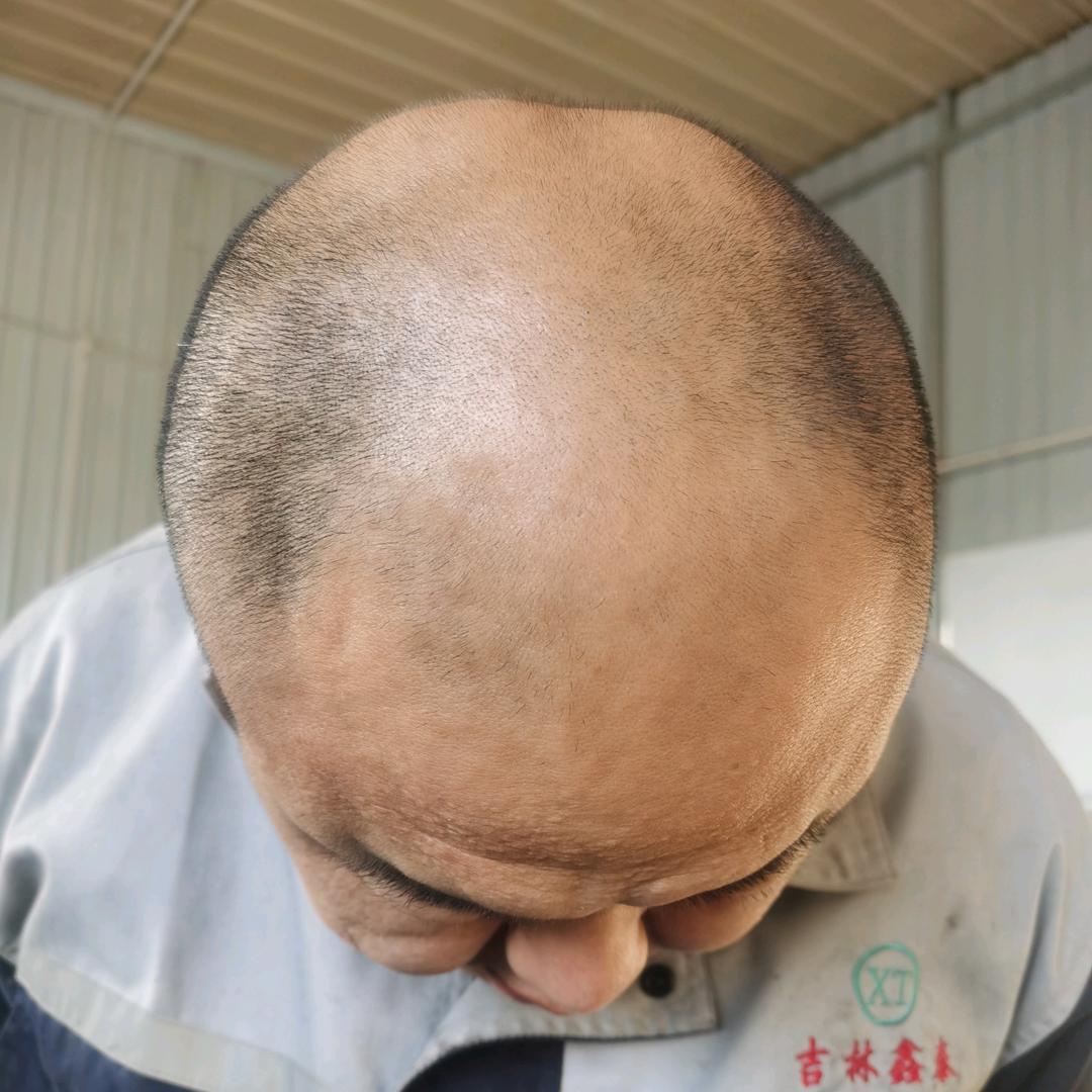 记录植发分享效果