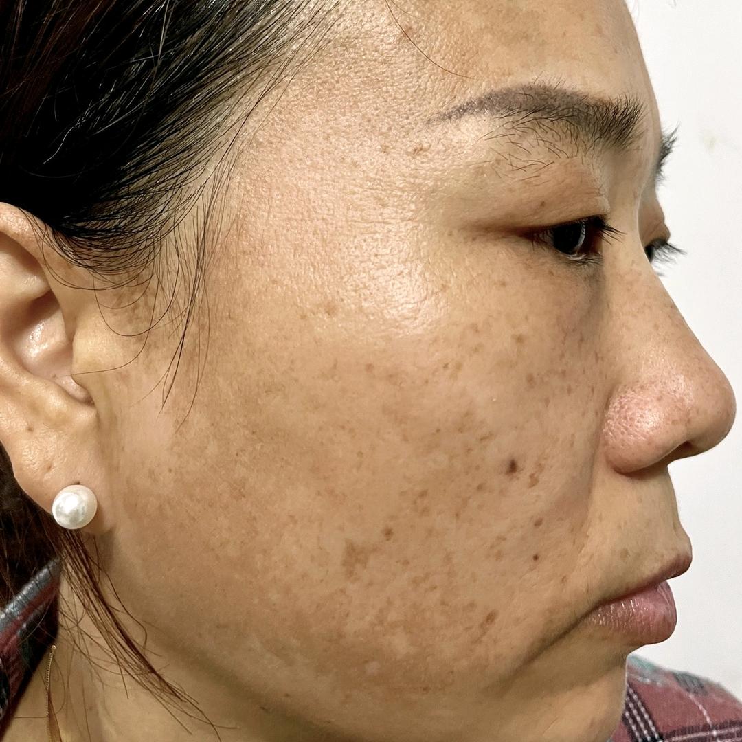 琴姐祛斑((养肤中))