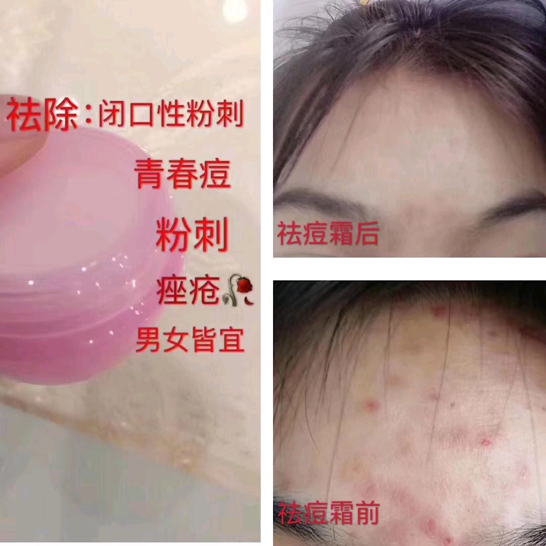 专治各种痘痘