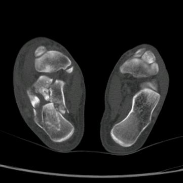 三火弟弟（跟骨骨折主理人）
