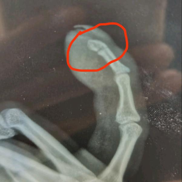 在中铁十一局受工伤了老板不管