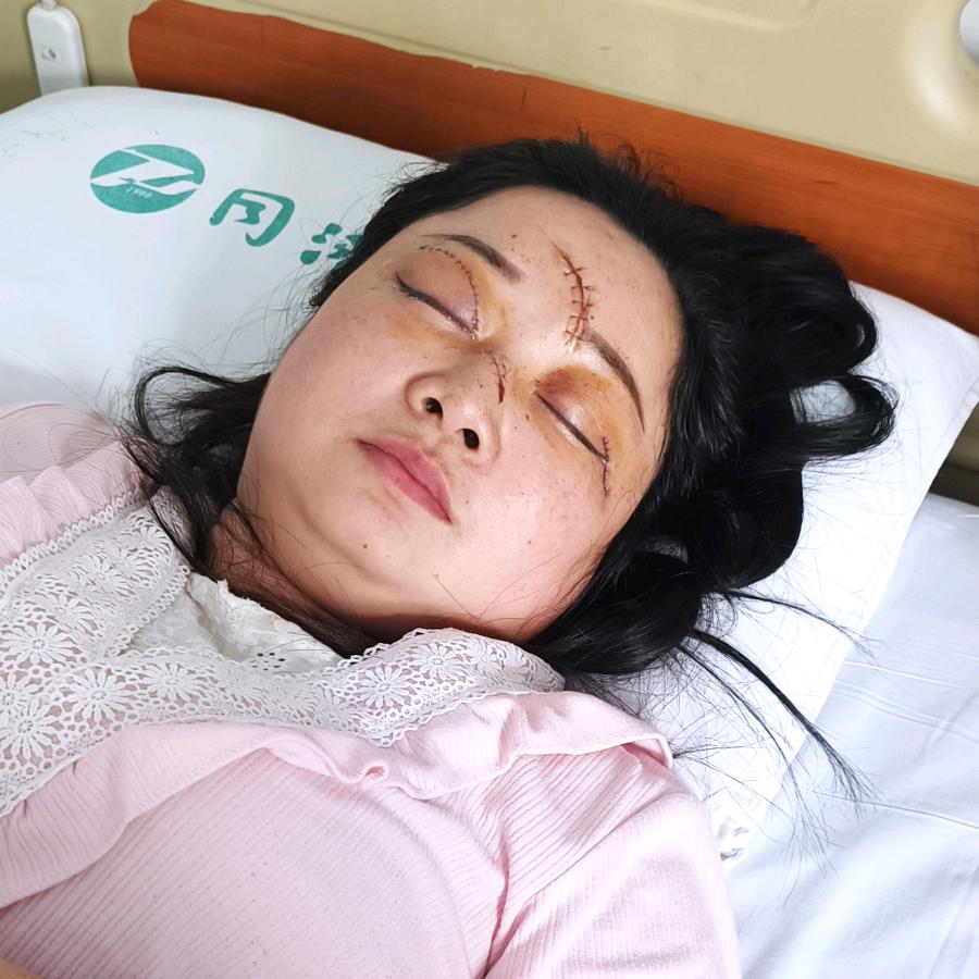 被家暴右眼失明的女孩